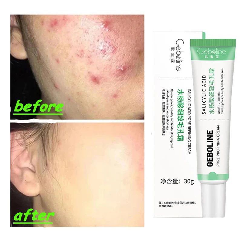 Salicylic Acid Pore Shrinking Cream Quick Elimination Large Pores