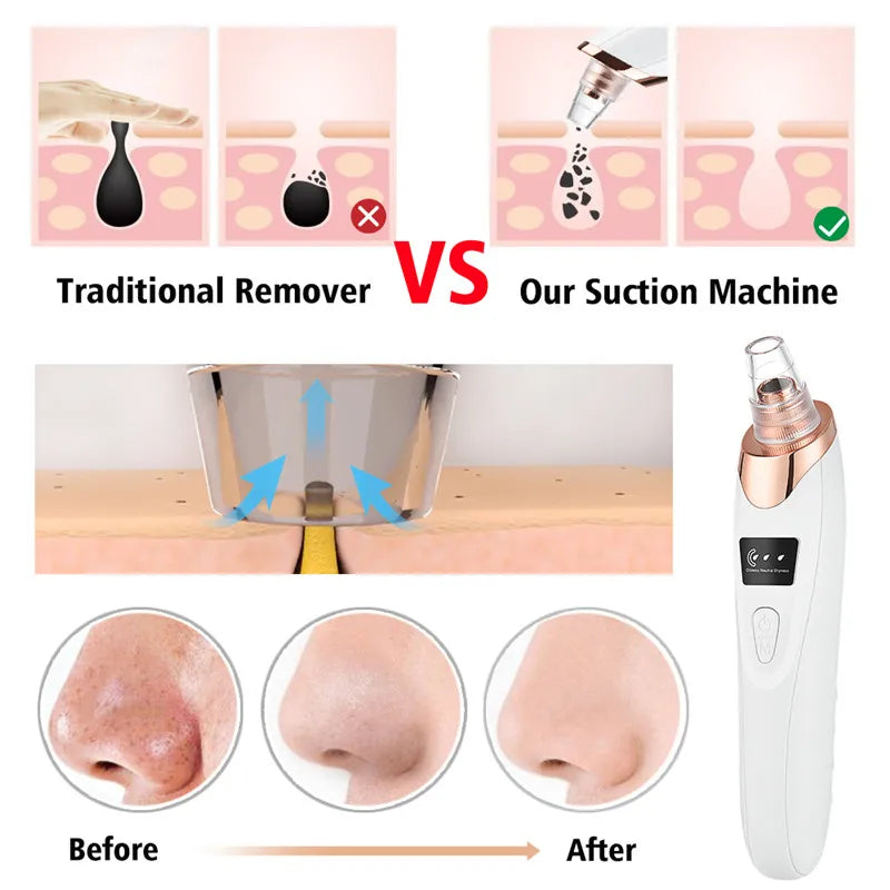 Facial Pore Cleaner Blackhead Remover Vacuum Suction